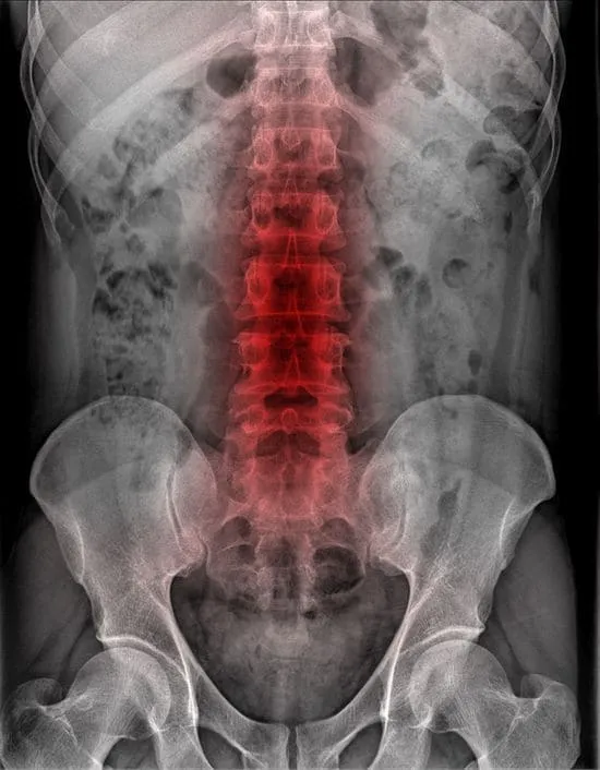 التهاب العمود الفقري — أشعة سينية
